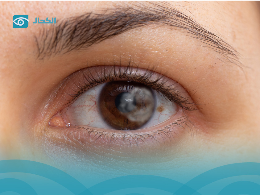 سبب ظهور خيوط سوداء