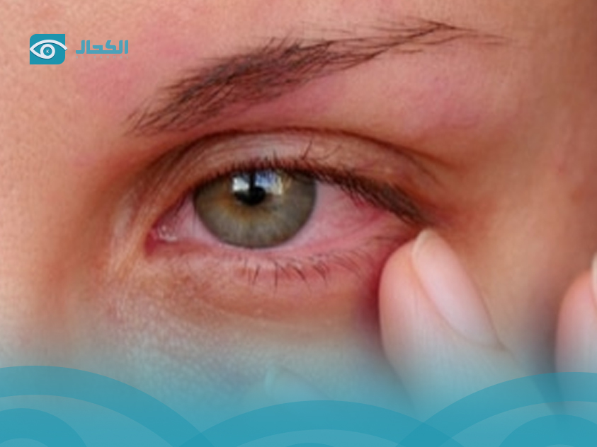 أعراض التهاب العين