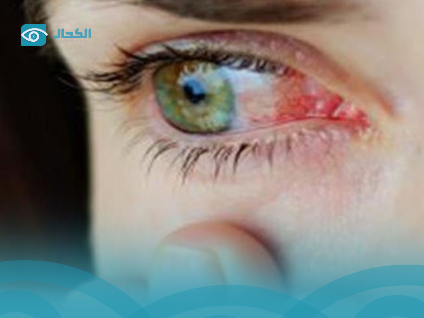 ذبابة-العين