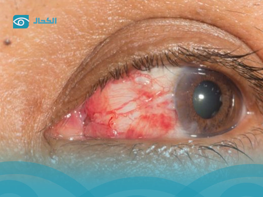 خدش-القرنية