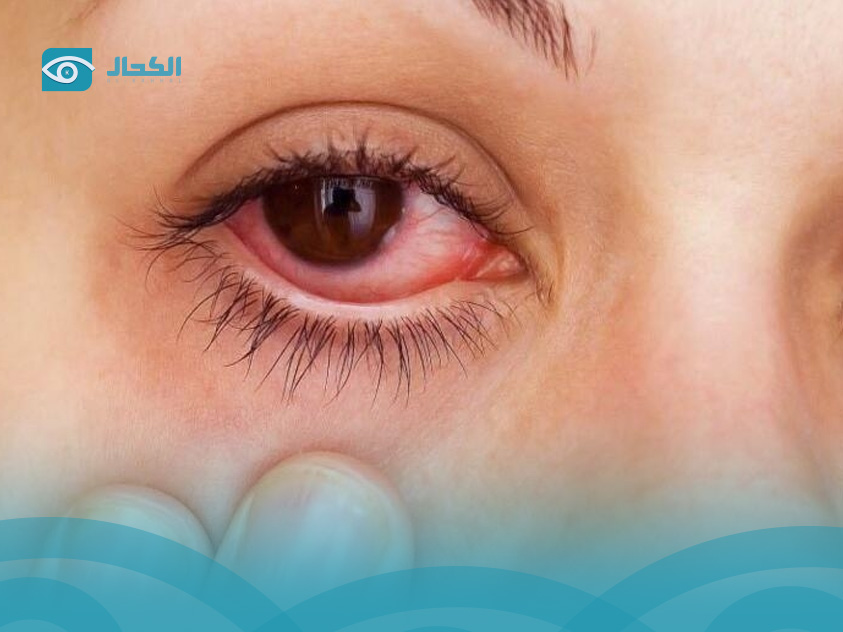 علاج-رمد-العين