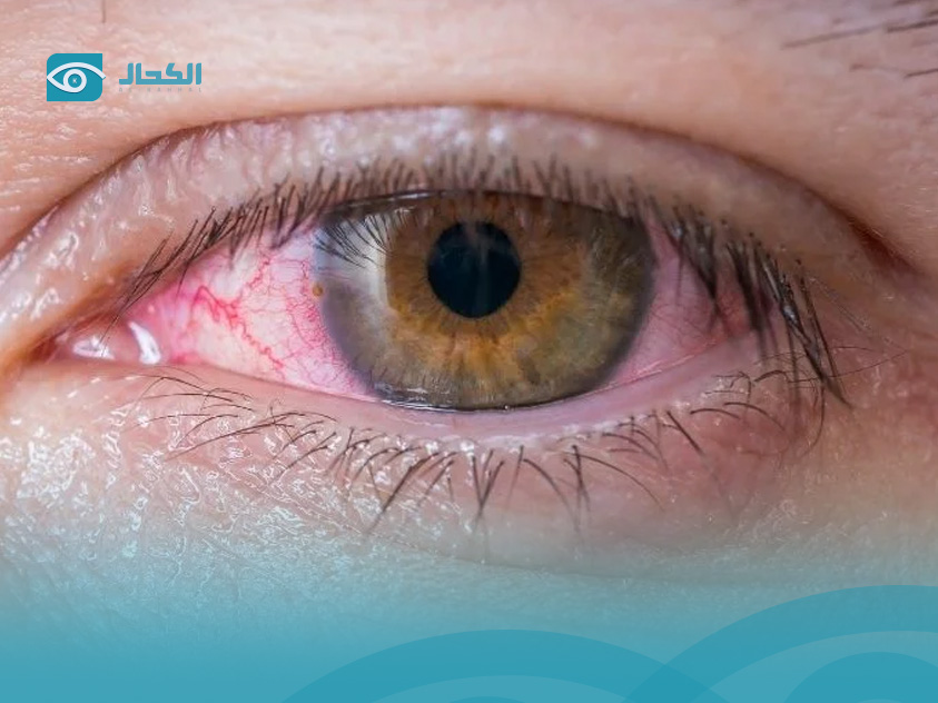  التهاب-الملتحمة-التحسسي
