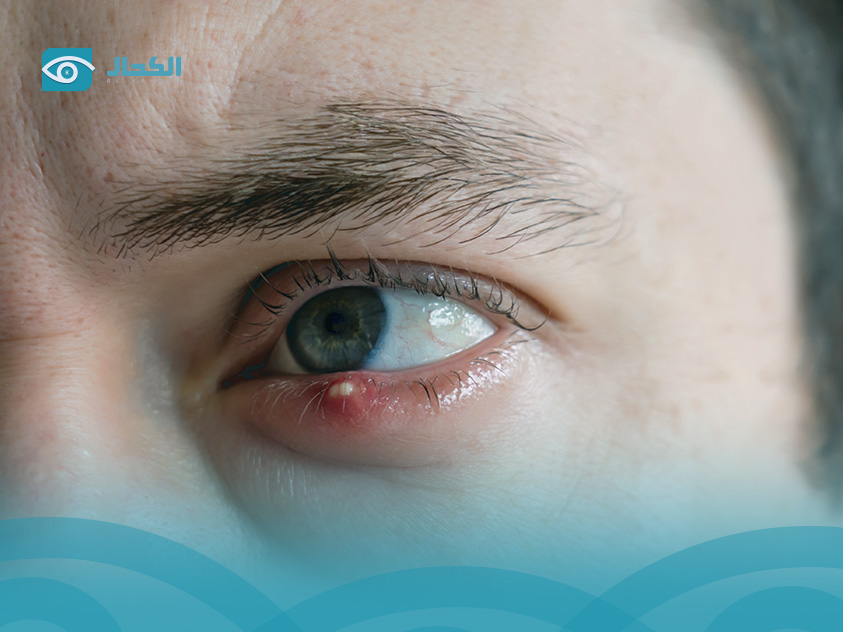 انتفاخ هربس العين