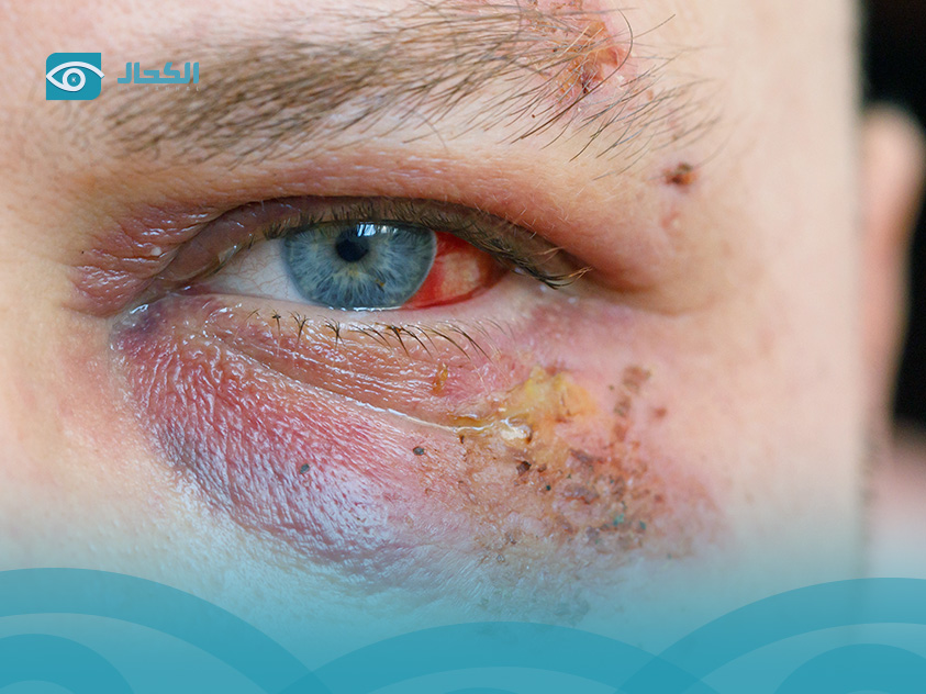 هربس العين اعراضه