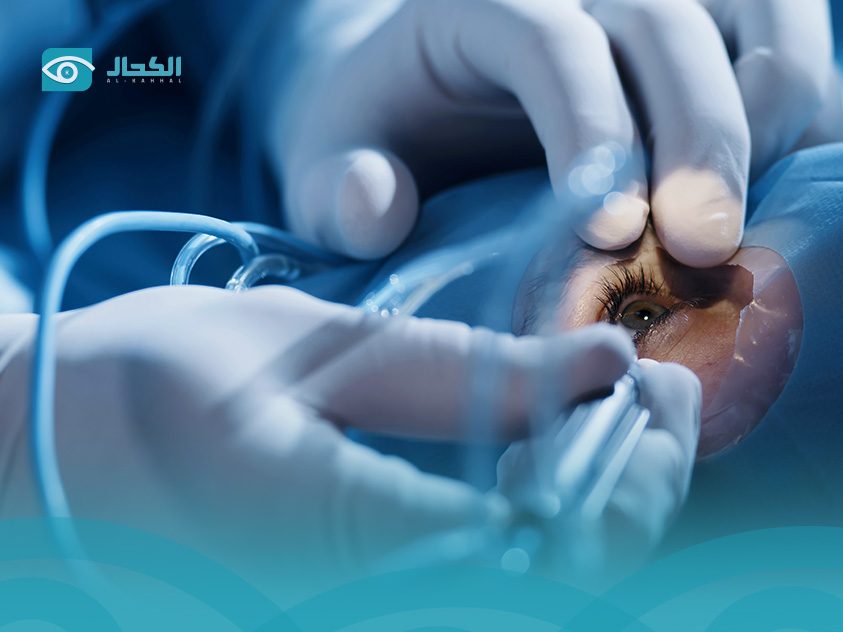 عملية تصحيح النظر