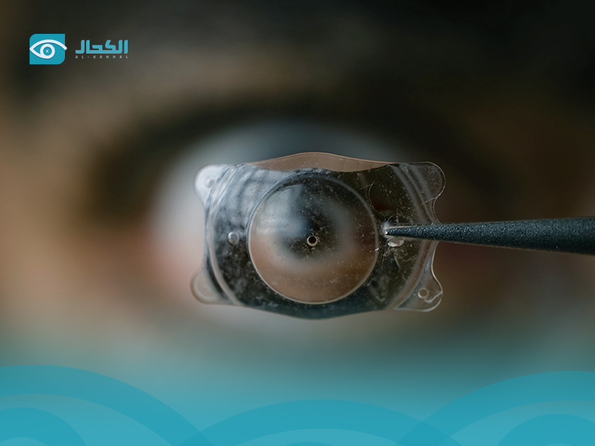 زرع عدسة ICL