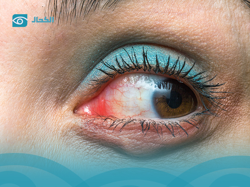 كيس-دهني-داخل-العين