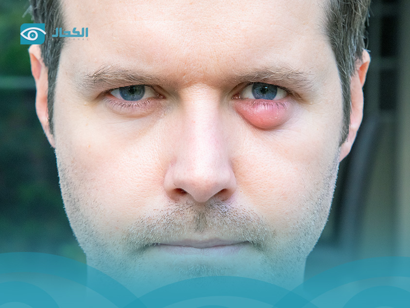 الكيس-الدهني-في-العين