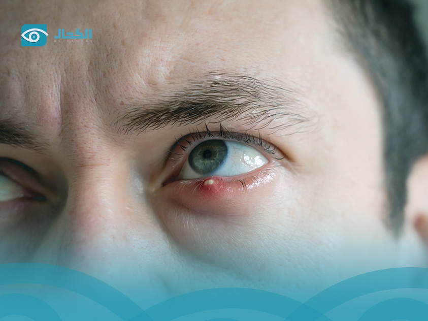 الكيس-الدهني-في-العين