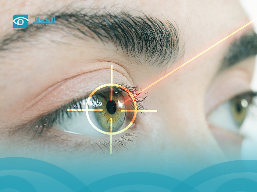 عملية-الكاستم-ليزك