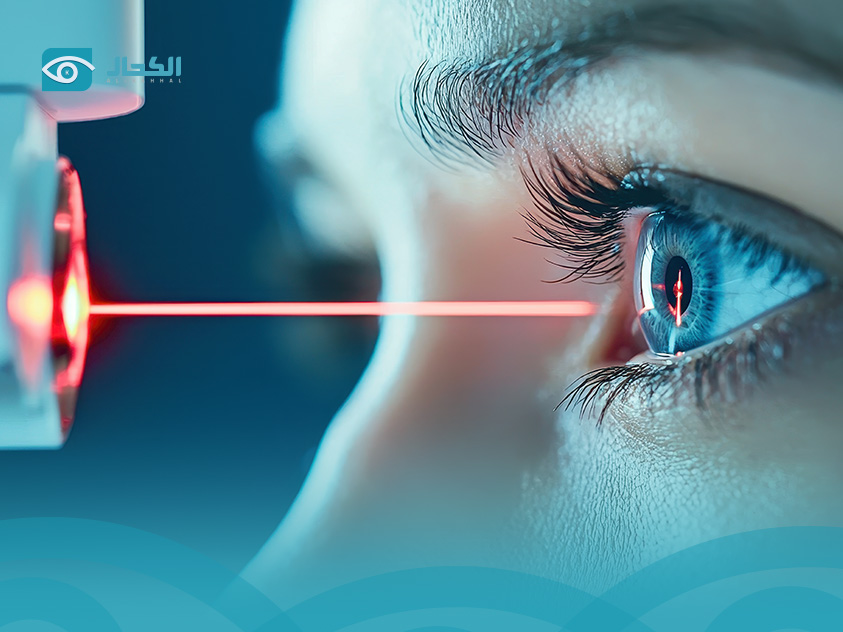 عملية-الكاستم-ليزك