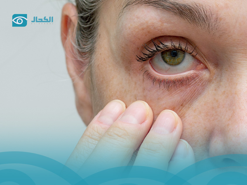 علاج-جفاف-العين