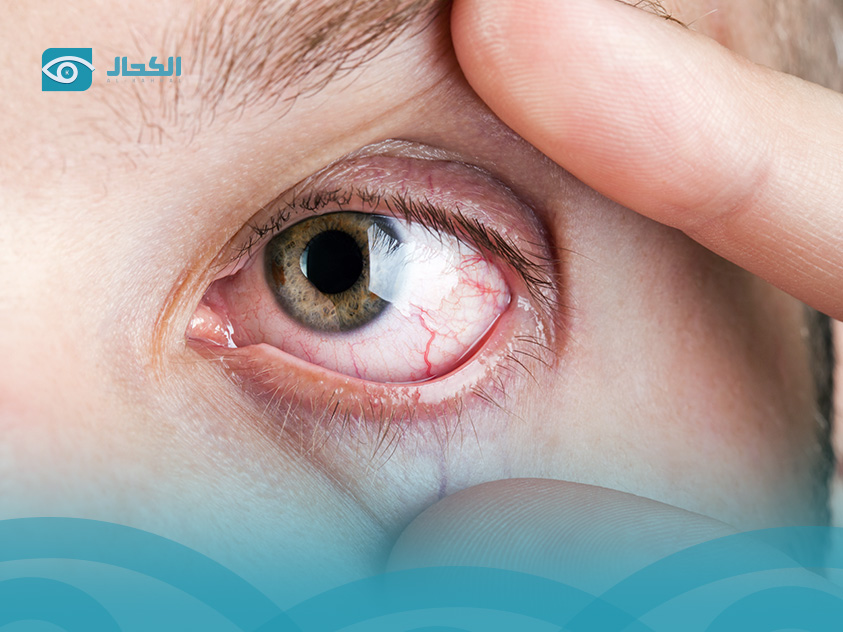 اسباب-جفاف-العين-وعلاجه