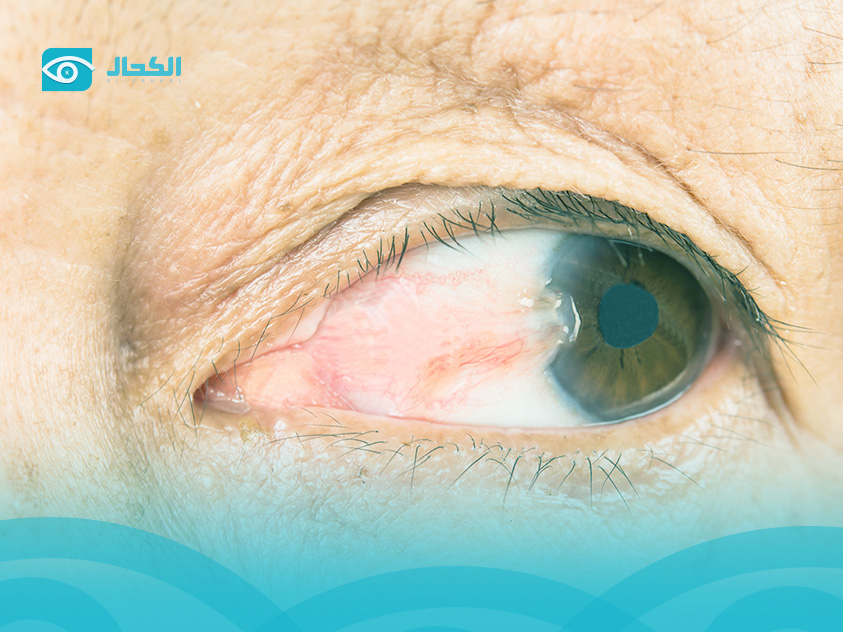 علاج-تمزق-غشاء-العين