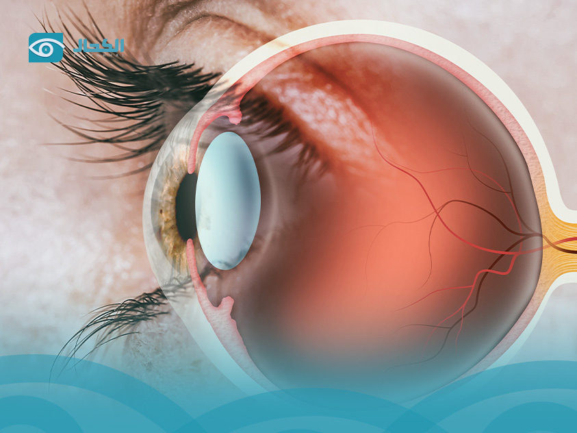 اعراض-شبكية-العين
