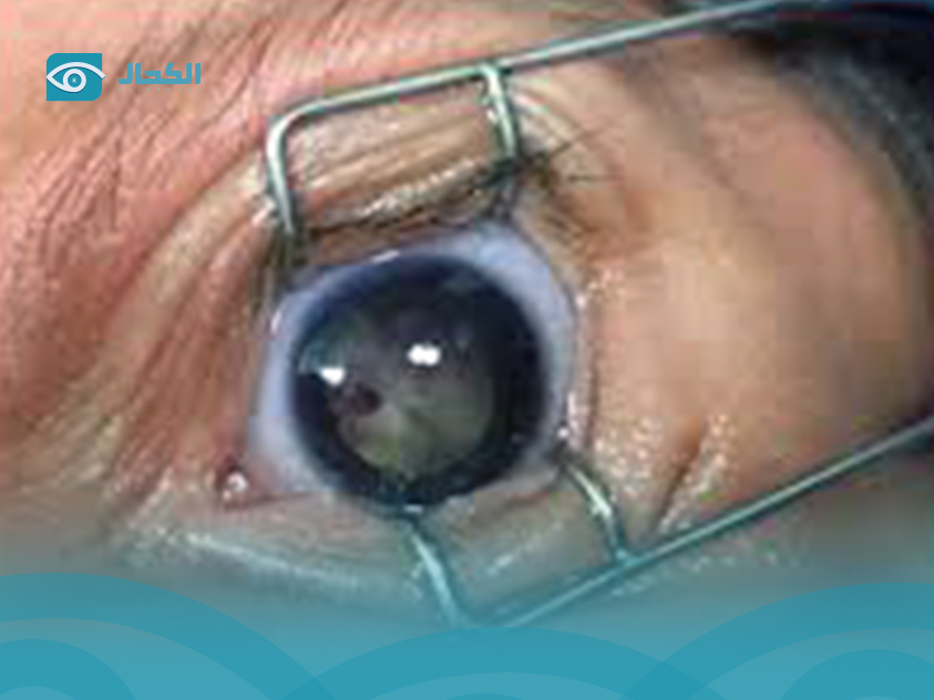 تكلفة فحص قاع العين