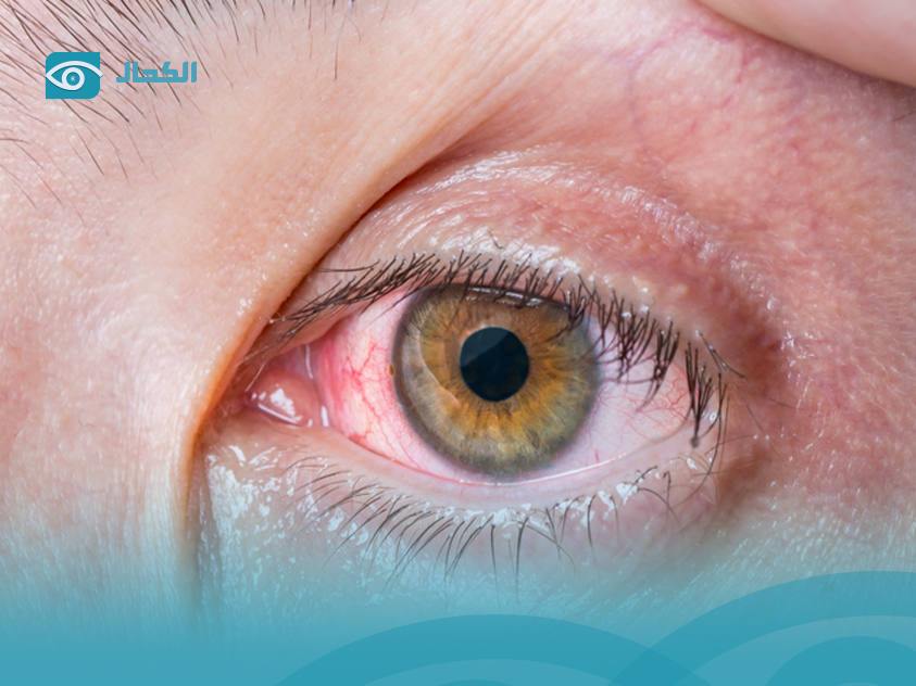 علاج-رمد-العين علاج-رمد-العين