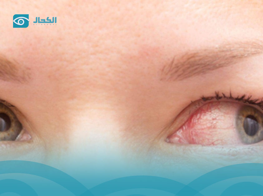 رأرأة-العين