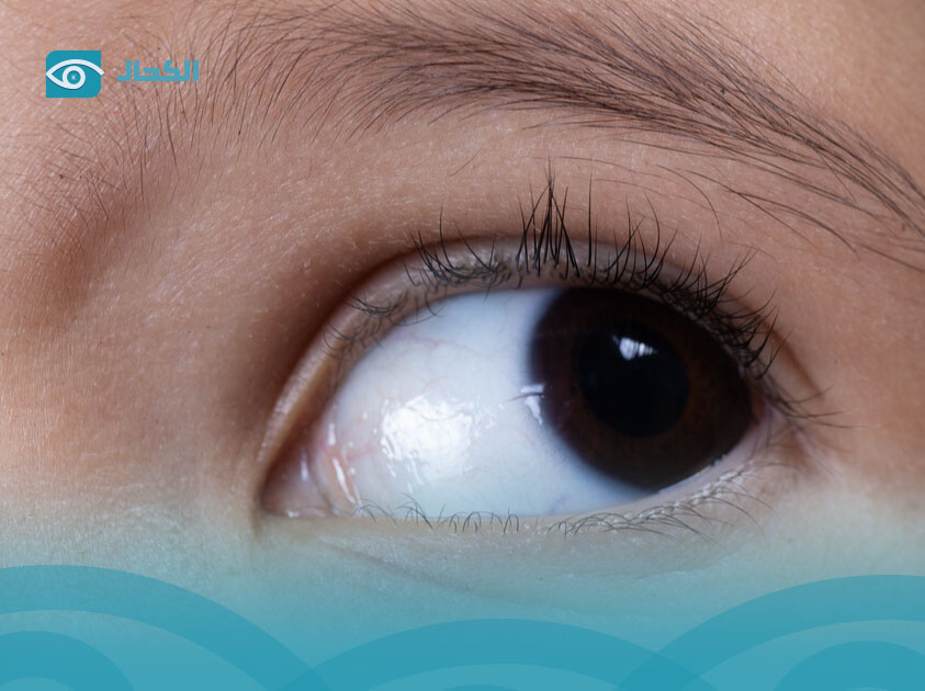 رأرأة-العين