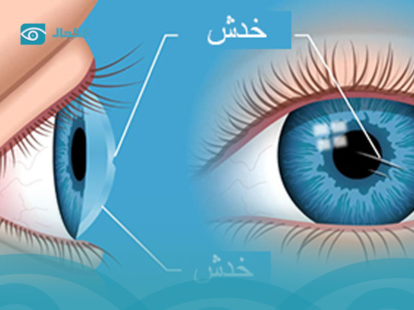 خدش-القرنية خدش-القرنية