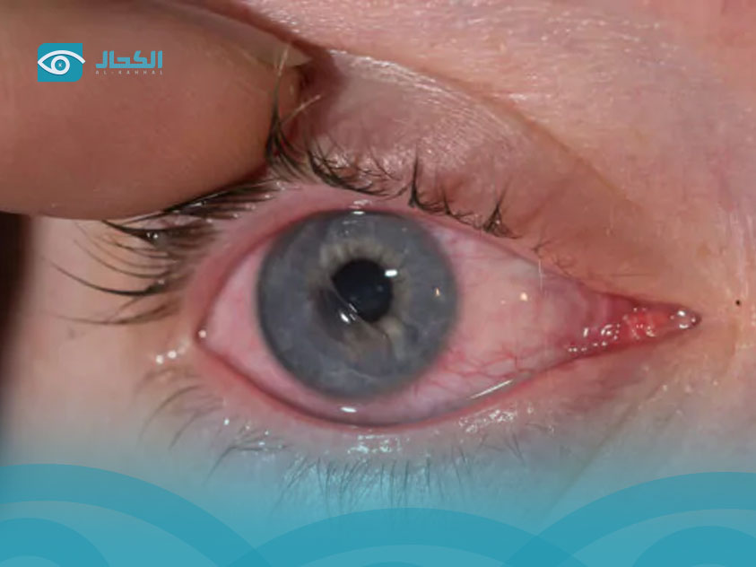 خدش-القرنية خدش-القرنية