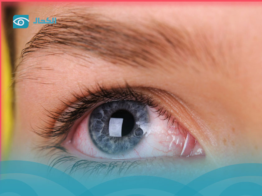 خدش-القرنية خدش-القرنية