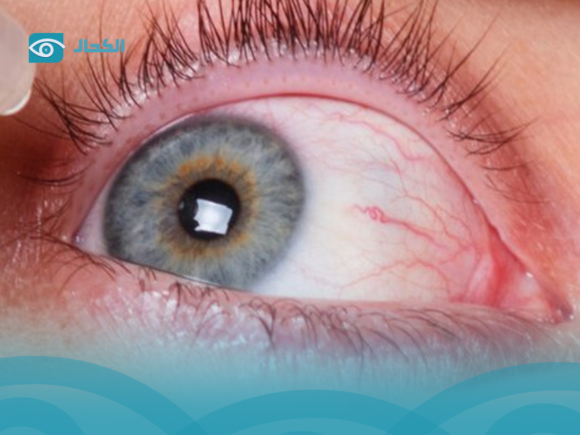 التهاب-العين-الفيروسي