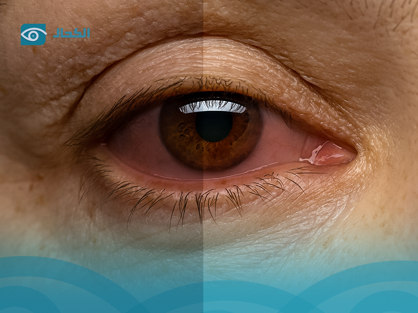 اسباب-اعتلال-الشبكية