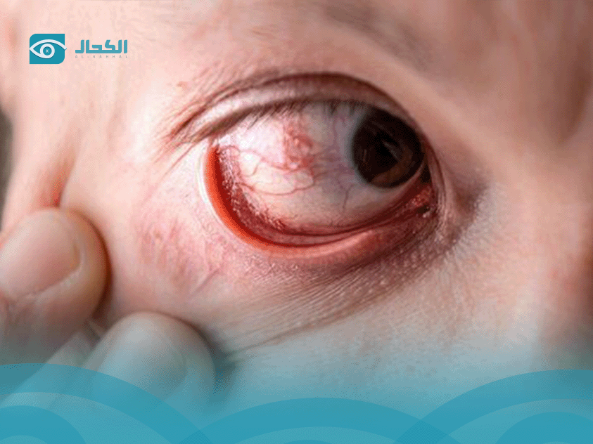 جلطة-في-العين