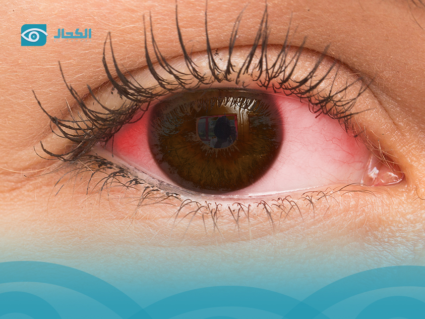 حكة العين واحمرارها