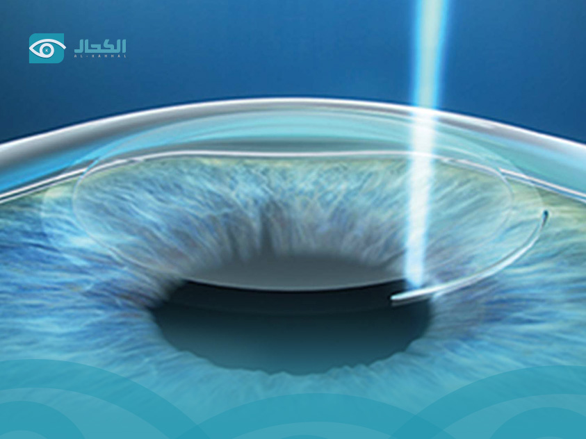 Deference between smile pro surgery and smile eye surgery