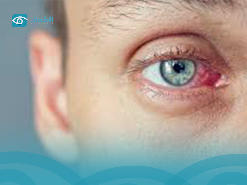 what causes eye infection