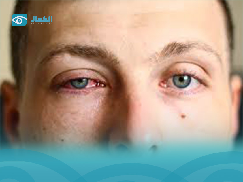 Medicine for Eye Infections