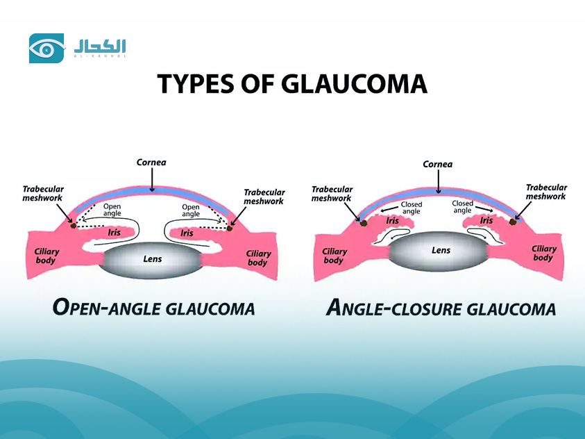 types of glaucoma