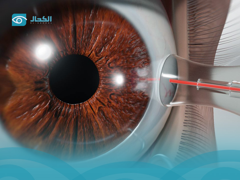 treatment of glaucoma