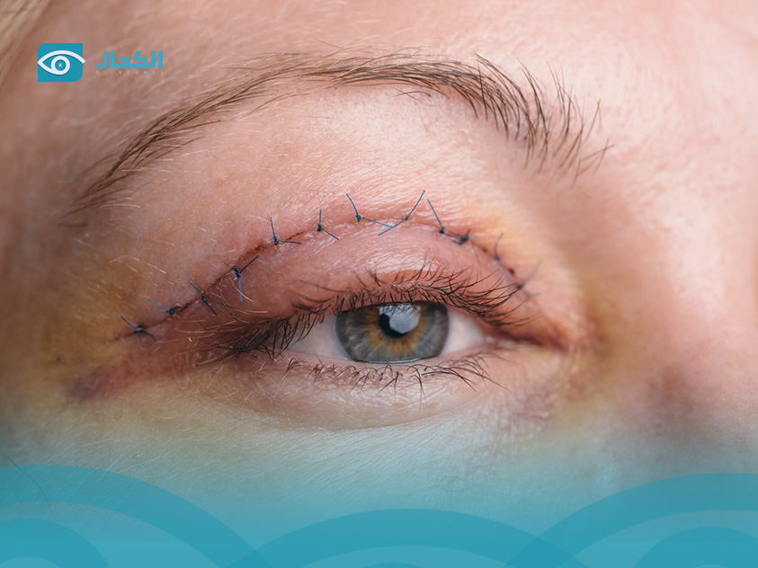 What-is-eyelid-surgery