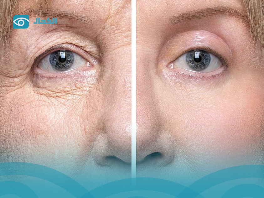 eyelid-surgery-before-and-after