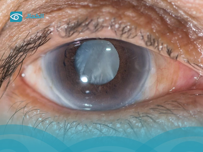 cataract surgery recovery time