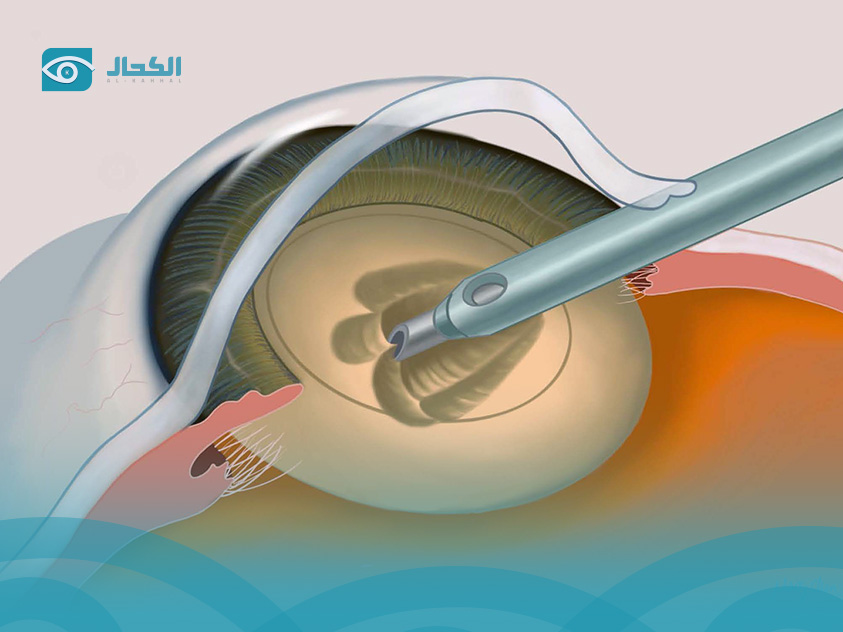 Benefits of Laser Cataract Surgery