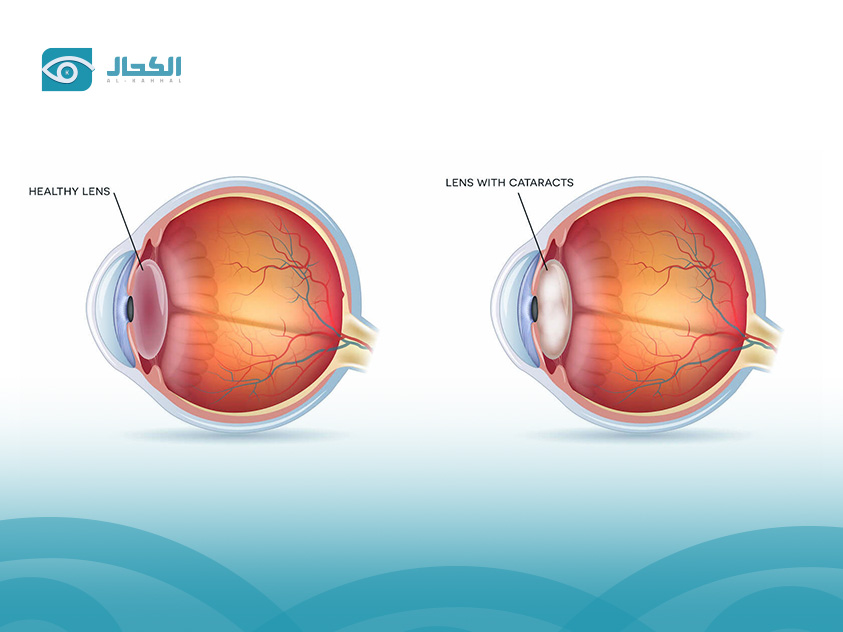 types of cataract surgery