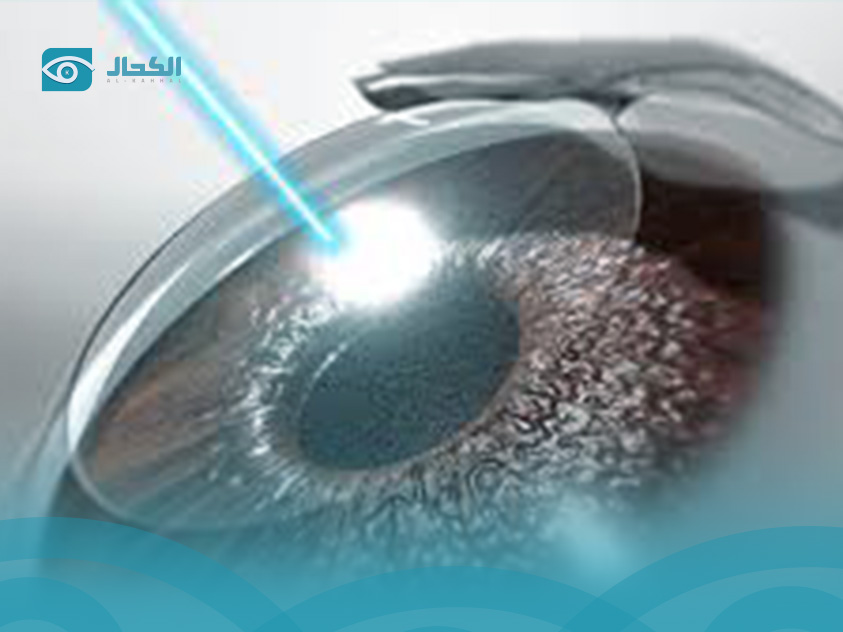 Before and After Lasik Eye Surgery