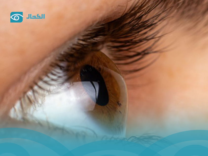 ما هي القرنية المخروطية