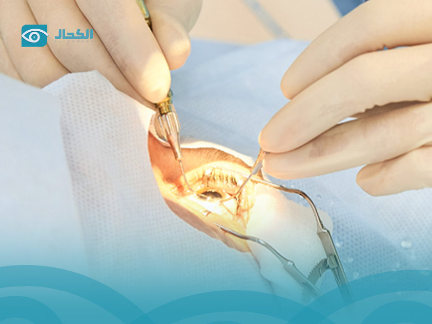 أعراض القرنية المخروطية