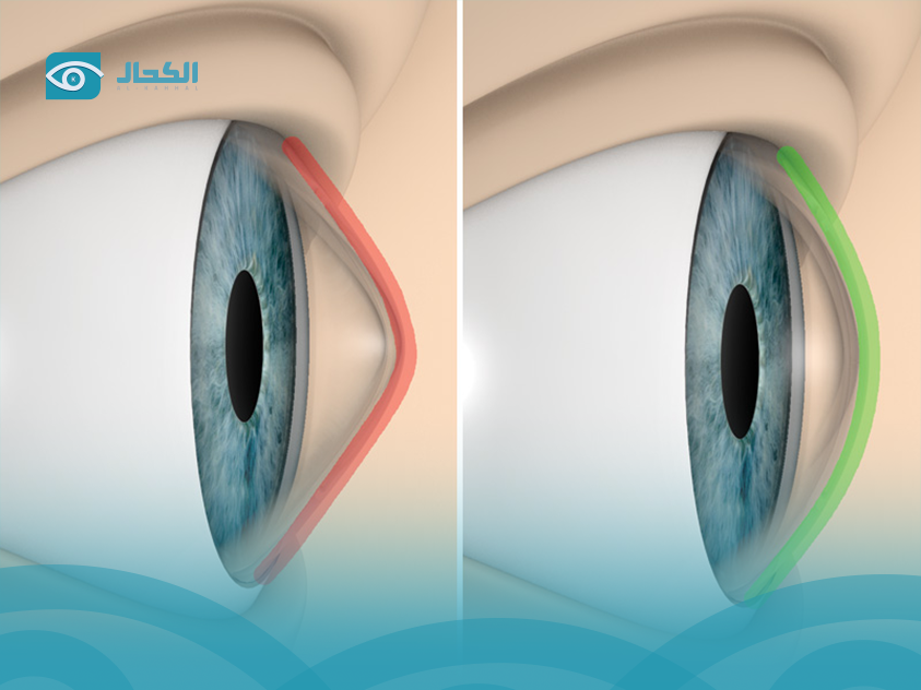 علاج القرنية المخروطية