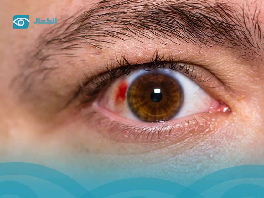 أسباب-البقع-في-العين