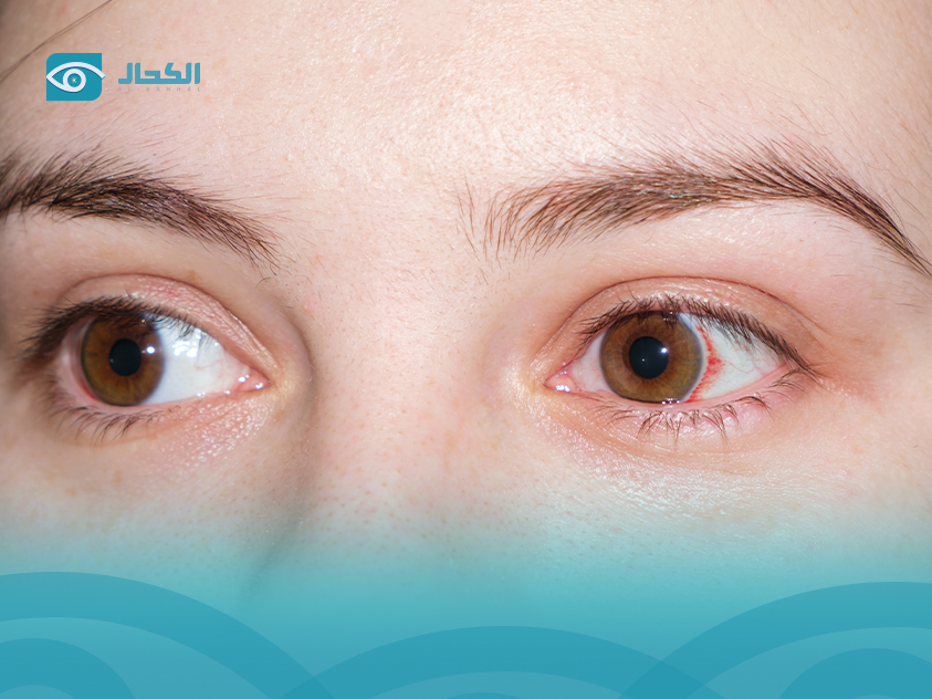 البقع-في-العين