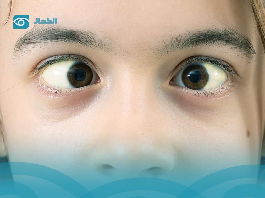 إفرازات العين الصفراء عند الأطفال