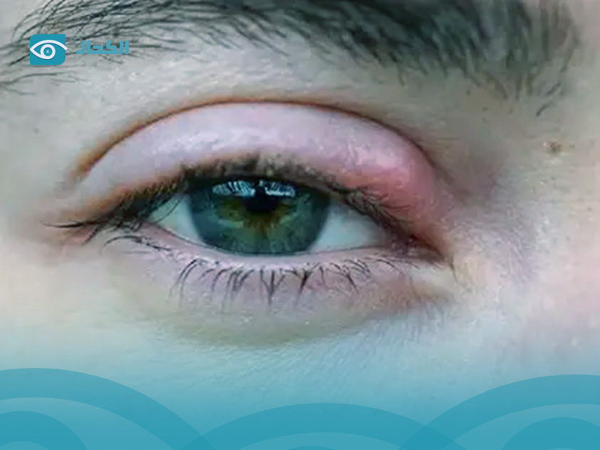 أسباب التهاب الجفون