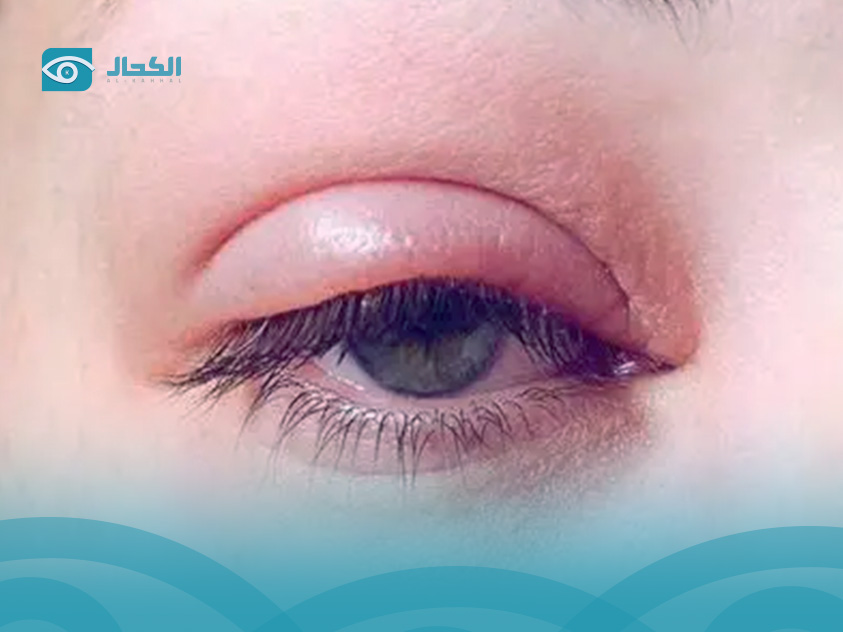 أسباب التهاب الجفون