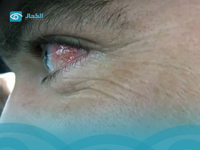 علاج التهاب العين